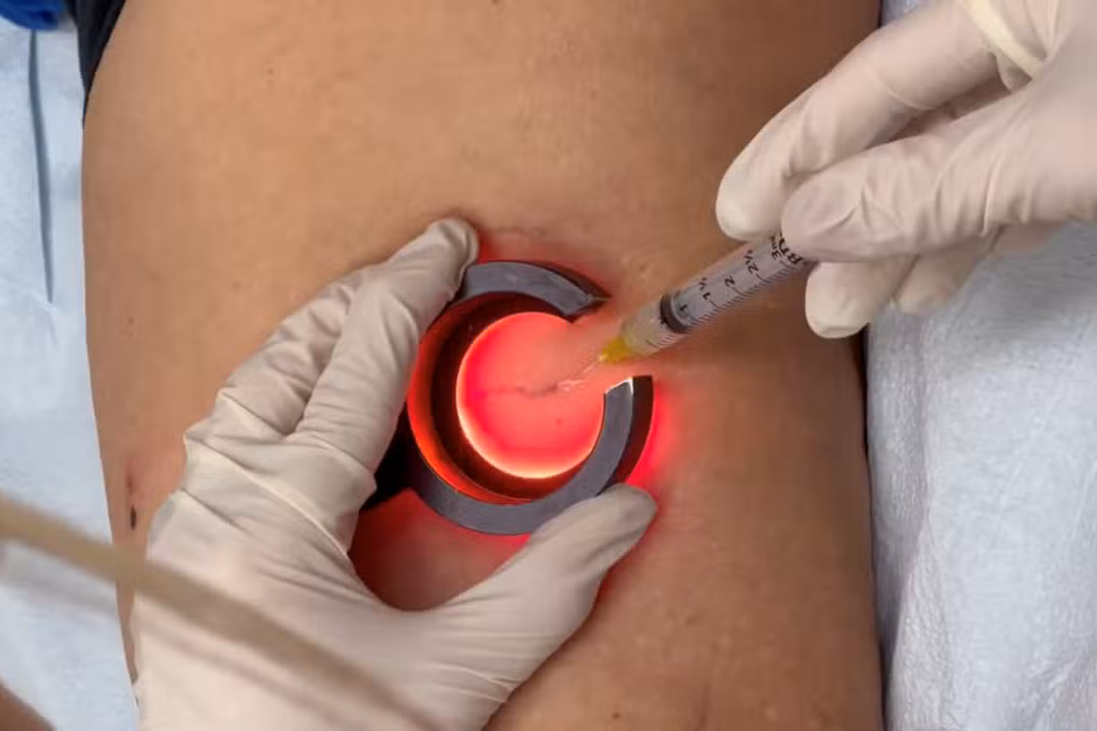 Vein Treatments in Walnut Creek, CA